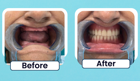 Before and After clinical photo of full-arch smile rehabilitation