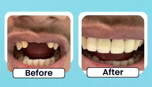 Before and After clinical photo of anterior tooth restoration