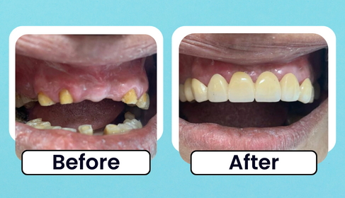 Before and After clinical photo of upper arch fixed restoration
