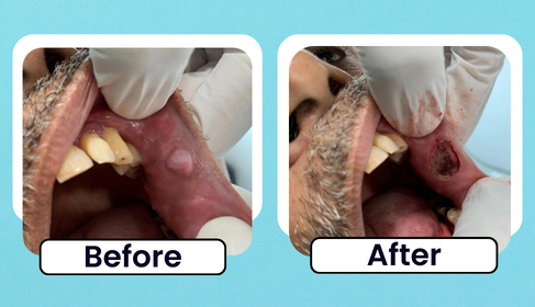 Before and After clinical photo of labial nodule excision