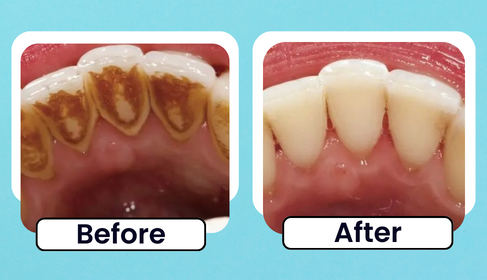 Before and After clinical photo of professional scaling and calculus removal